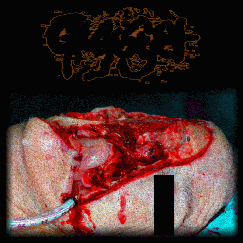 Surgical Resection of Massive Squamous Carcinoma Resulting in Facial Disfigurement